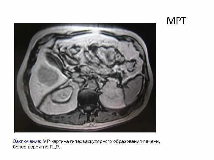 Гиперваскулярное образование печени. Гепатоцеллюлярная карцинома печени мрт. Гиповаскулярное образование в печени на кт что это.