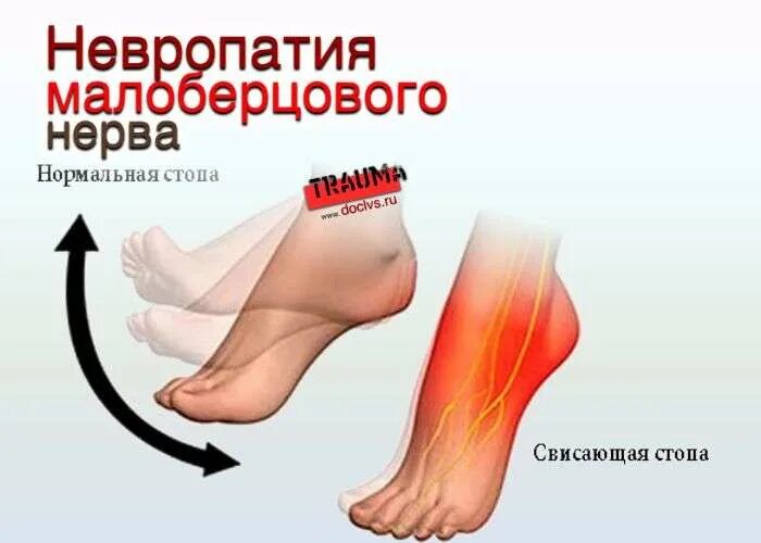 Нейропатия малоберцового нерва. Нейропатия большеберцового нерва. Большеберцовая и малоберцовая нейропатия. Синдромы поражения малоберцового нерва.