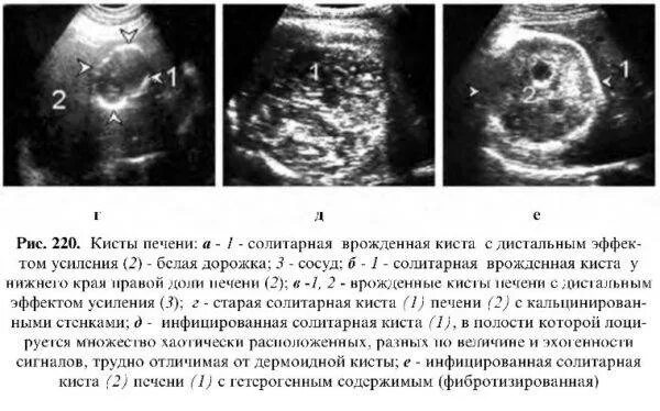 Киста печени форум. Паразитарная киста печени. Солитарные кисты печени.