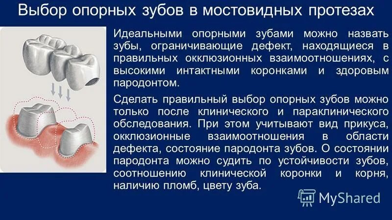Что такое депульпирование зуба перед протезированием. Требования предъявляемые к опорным зубам мостовидного протеза. выбор опорных зубов. требования к опорным зубам мостовидный протез. препарирование опорных зубов под мостовидные протезы.