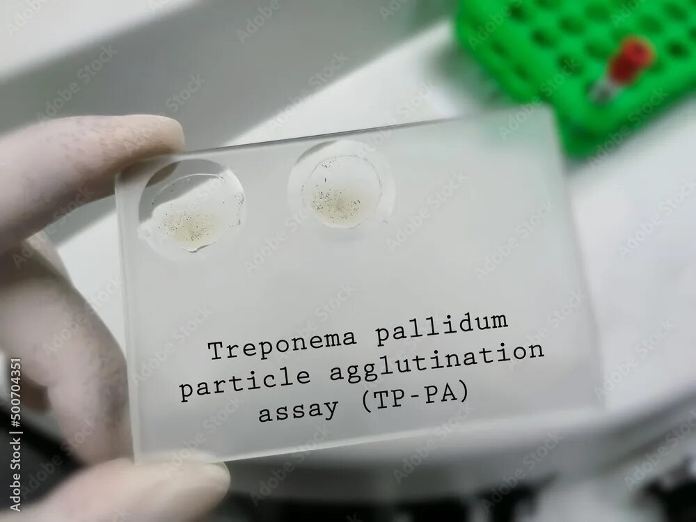 Treponema pallidum в рмп качественно. Treponema pallidum Particle agglutination Assay. Трепонема паллидум над губой. Трепонема паллидум на губе. Treponema pallidum на разных средах.