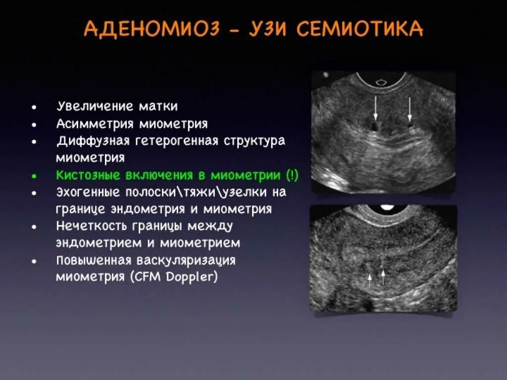 Аденомиоз . Патология эндометрия. Патология эндометрия УЗИ. Диффузно очаговые образования