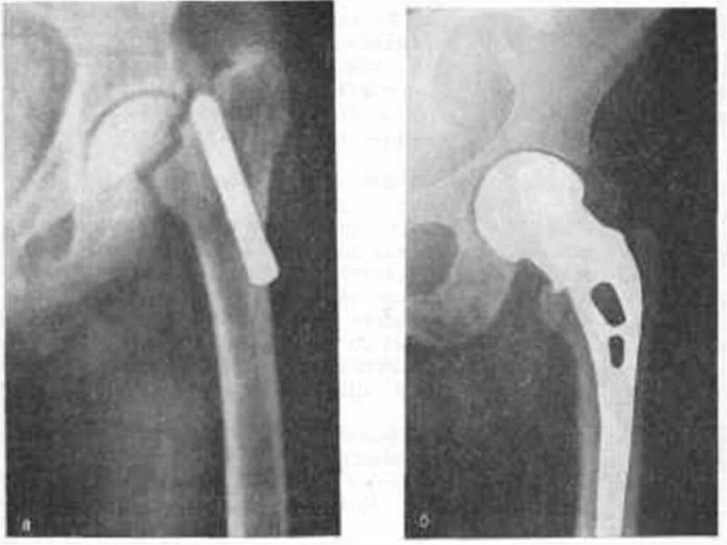 Последствия перелома шейки бедра. Перелом шейки бедра остеосинтез. Перелом шейки бедра остеосинтез рентген. Перелом шейки бедра штифт. Ложный сустав шейки бедренной кости.