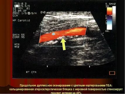 Атеросклероз нижних конечностей узи