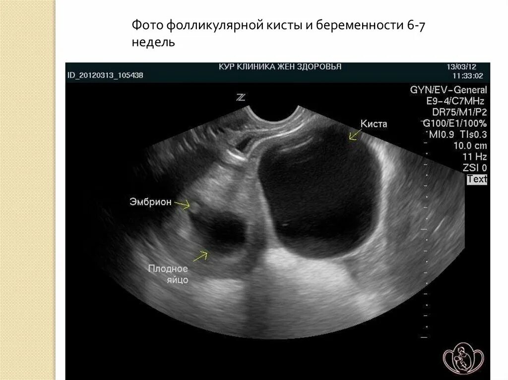 Как отличить кисту. Фолликулярная киста яичника на УЗИ. Эндометриоидная киста яичника. Фолликулярнаякисты яичника УЗИ. Фолликулярная киста на УЗИ.