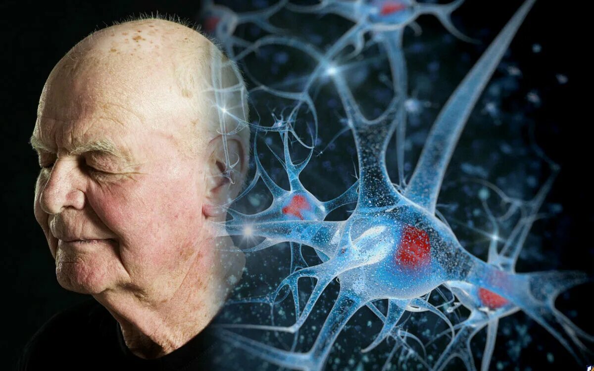 Brain disease. Деменция Альцгеймера. Уилкинсон Джон болезнь Альцгеймера. Старение человека.