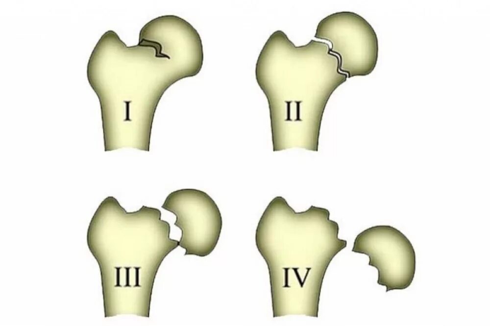 Перелом шейки бедра в пожилом возрасте. Классификация переломов шейки бедренной кости. Переломы шейки бедра классификация. Медиальный перелом шейки бедра. Классификация переломов бедренной кости.
