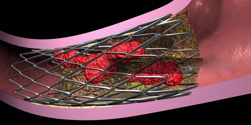 Стент Промус премьер. Коронарная ангиопластика и стентирование. Стенты Biomatrix. Голометаллические стенты. Стентирование прогнозы