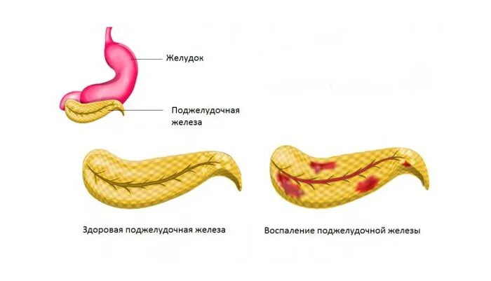 Панкреатит действие. Что такое панкреатит поджелудочной. Больной с острым панкреатитом.