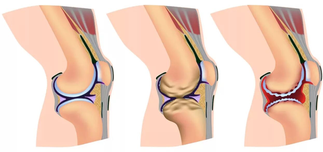 Колена ли. Гонартроз коленного сустава 1. Гонартроза коленного сустава 1. Ревматоидный гонартроз коленного. Первичный гонартроз двусторонний.