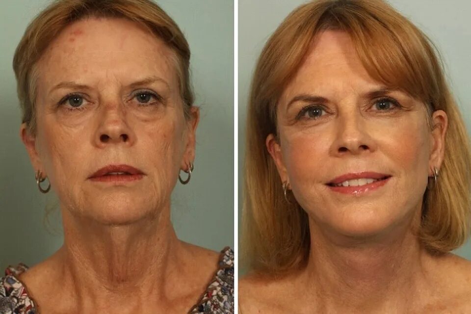 Омоложение до и после. Омоложение до и после. Омоложение лица до и после. Лазерное омоложение лица до и после. Лазерный лифтинг фраксель.