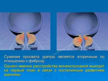 Мочеиспускание после тур