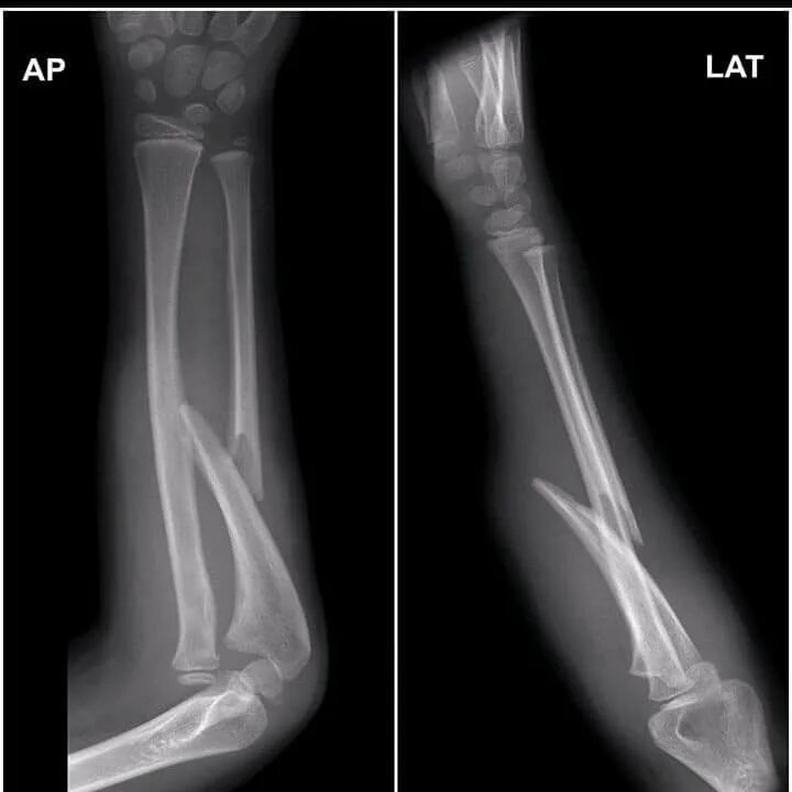 Fracture modeling
