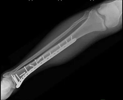 Break bone