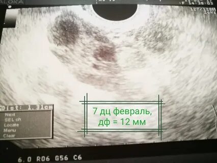 Фолликулы уменьшены
