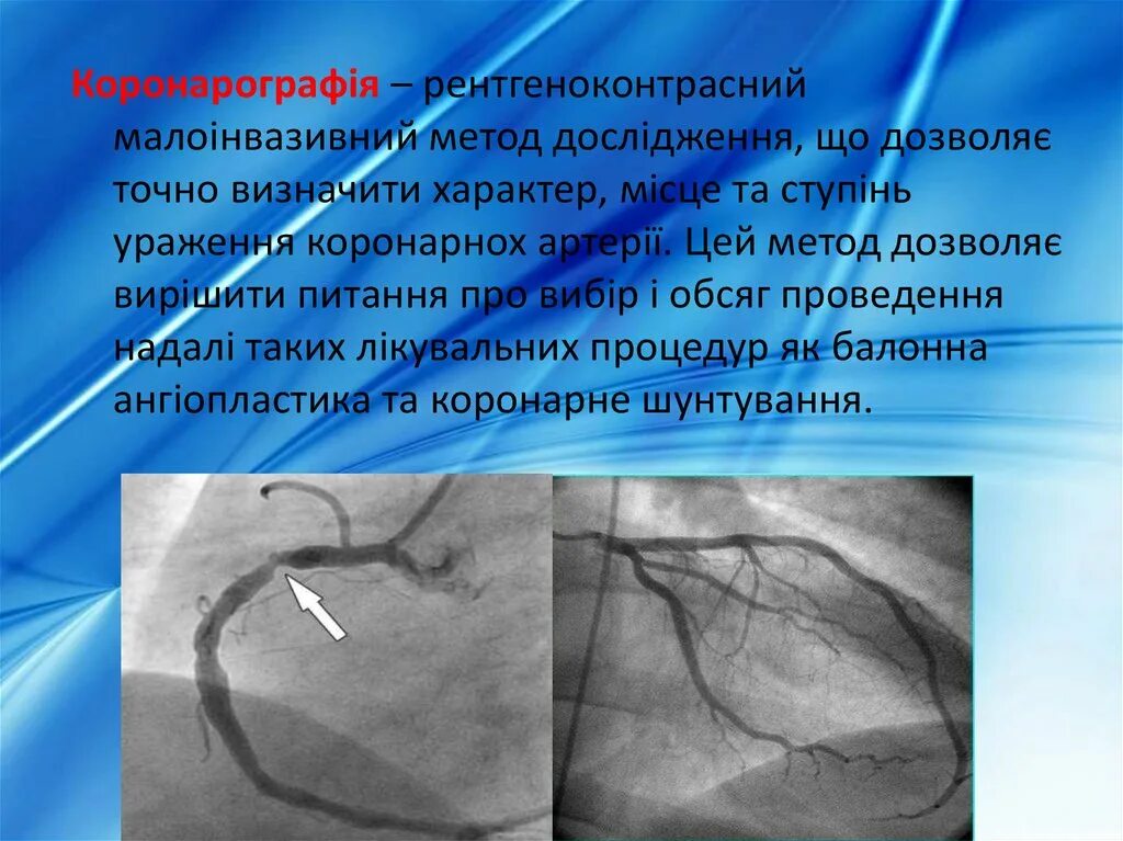 Коронарография сосудов сердца. Коронарография исследования. Инвазивная коронарография.