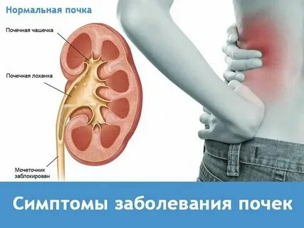 Первые признаки почки больные