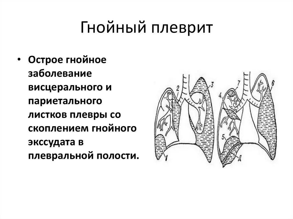 клинические проявления гнойного плеврита. гнойный плеврит это. признак острого гнойного плеврита. острый гнойный плеврит ( эмпиема плевры). гнойный плеврит причины.