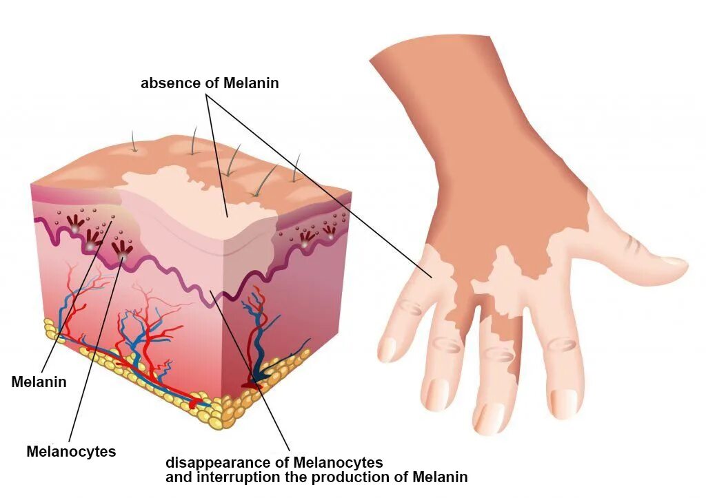 Меланоциты меланин кожа. Витилиго аутоиммунное заболевание. Кожа способна к