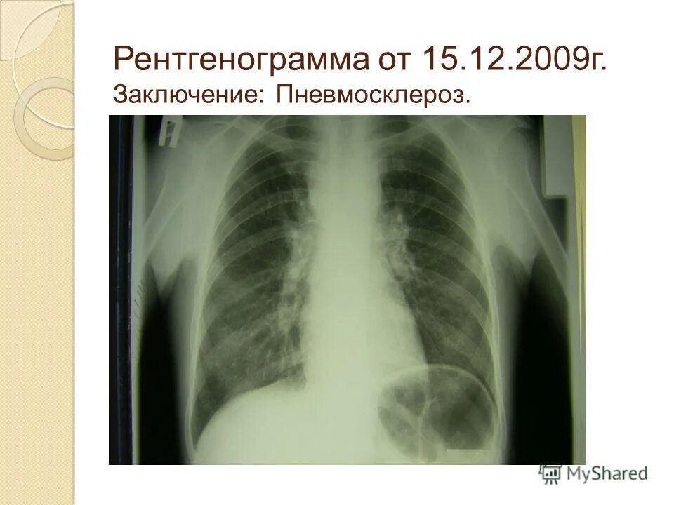 Пневмосклероз рентгенограмма. Посттуберкулезный пневмосклероз кт. Посттуберкулезный пневмофиброз. Пневмосклероз легкого рентген.