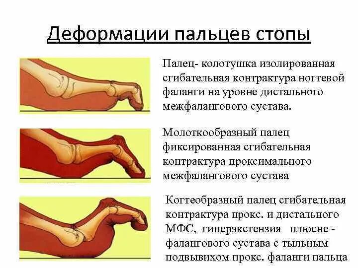 Сгибательная контрактура сустава. Молоткообразная деформация пальцев рентген. Деформация 2 пальца стопы рентген. Молоткообразная деформация пальцев операция. Молоткообразной деформации пальцев стопы.