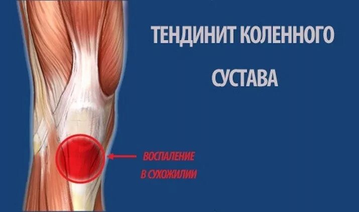 Боль под коленом спереди. Тендинопатия сухожилия подколенной мышцы. Тендинопатия сухожилия коленного сустава. Тендинит сухожилия подколенной мышцы. Воспаления сухожилия подколенного сустава.