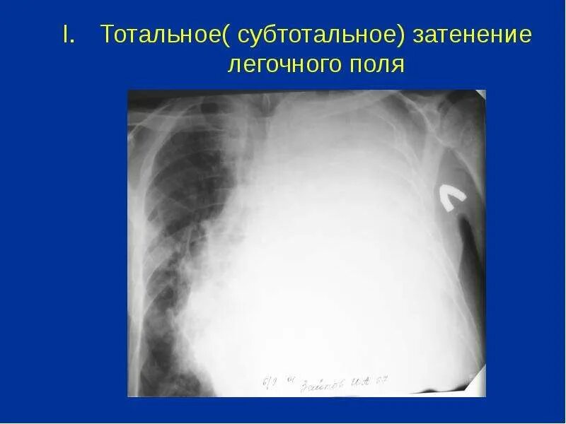 Тотальное отсутствие это. Синдром тотального затемнения легочного поля. тотальное и субтотальное затемнение легочного поля. субтотальное затемнение легких рентген. обширное затемнение легочного поля.