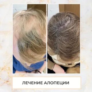 Лечение андрогенной алопеции у женщин отзывы