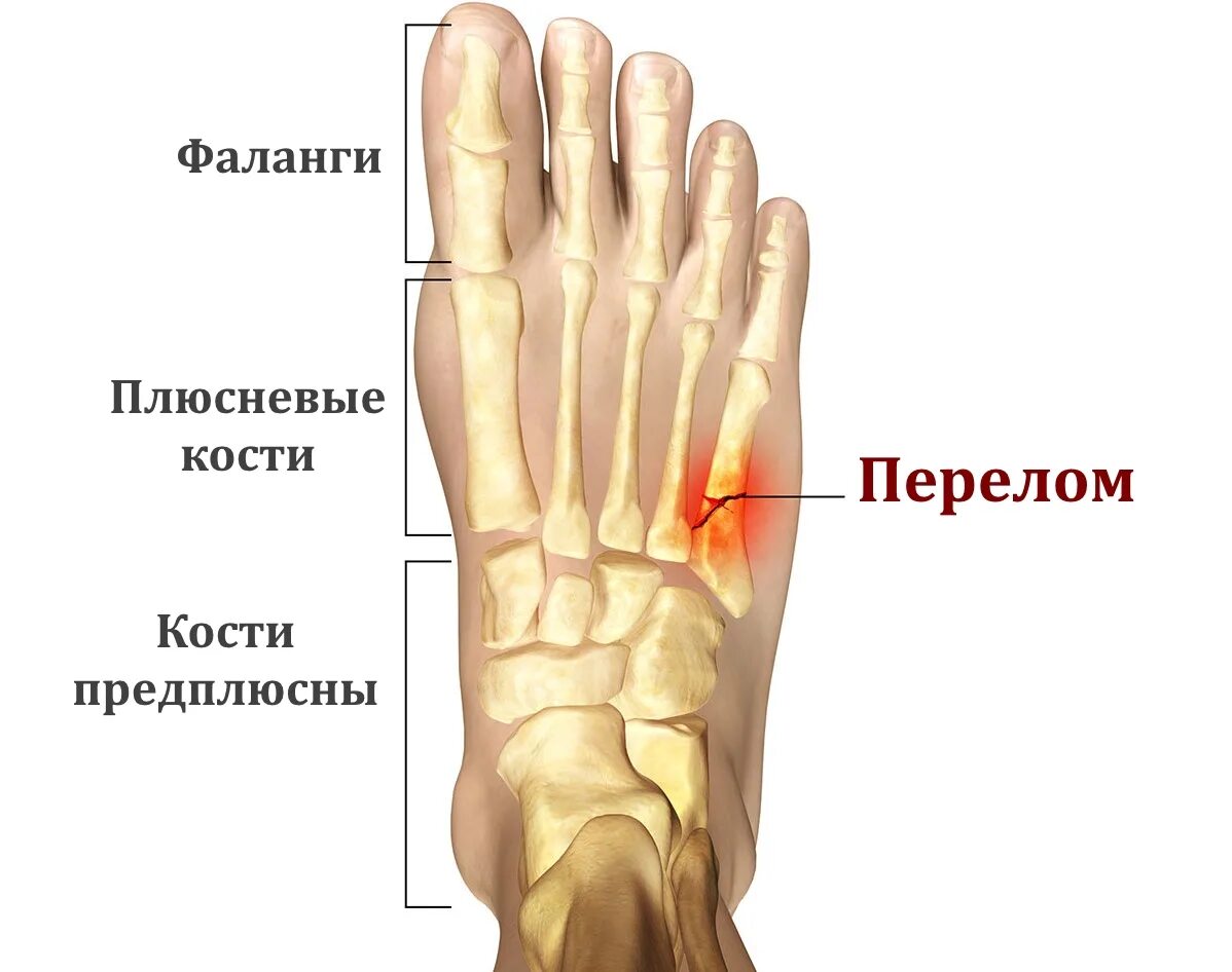 5 Плюсневая кость стопы. 5 Плюсневой кости стопы. Стрессовый перелом 5 плюсневой кости. Перелом 5 плюсневой кости стопы. Болят лучевые кости почему