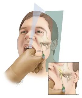 Placement of Needle in the Foramen The Neurosurgical Atlas