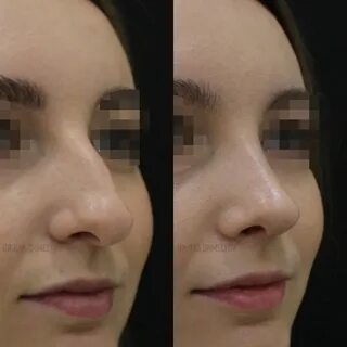 Неудачная ринопластика
