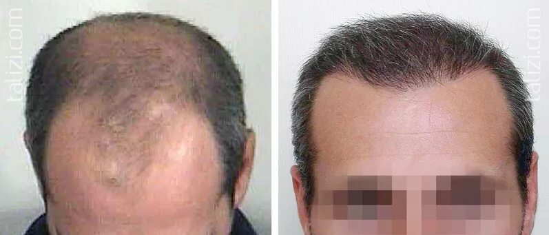 Пересадка волос воронеж. Доктор Чолак пересадка волос. Графт трансплантация волос 15000. До и после пересадки волос.