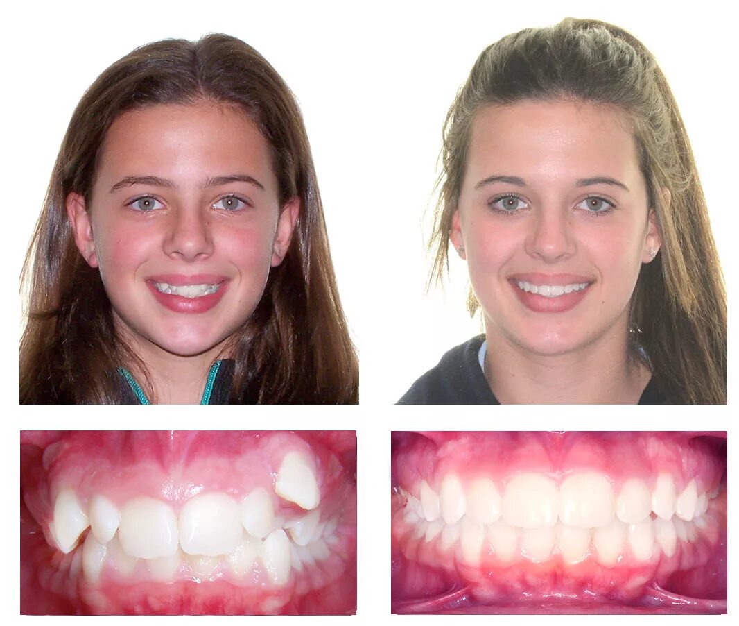 Изменения после брекетов. Ортогнатическая операция перекрестного прикуса. Перекрестный прикус до и после брекетов. Мезиальный перекрестный прикус.