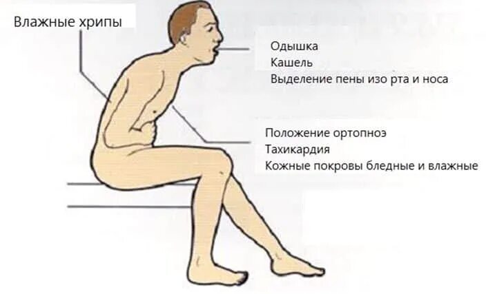 Положение ортопноэ это при отеке легких. Положение пациента при бронхиальной астме. Сердечная астма положение пациента. Положение ортопноэ при приступе бронхиальной астмы. Дыхание при сердечной недостаточности