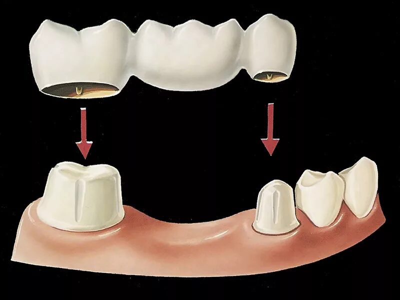 Несъёмный мостовидный протез челюсти. Зубной мост мостовидный протез. Мостовидный протез металлокерамика на 1 зуб. Металлокерамика зубной мост 3d+. 3 зуба установить