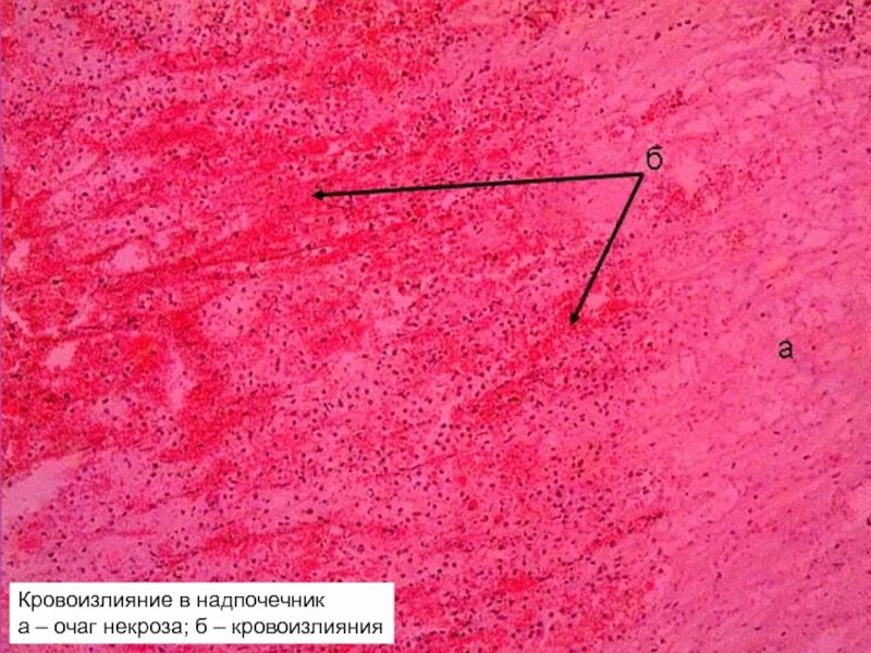 Микропрепарат головного мозга. Артериальная гиперемия гистология. Синдром Уотерхауса-Фридериксена патанатомия. Диапедезное кровоизлияние в надпочечник микропрепарат. Синдром Уотерхауса-Фридериксена гистология.