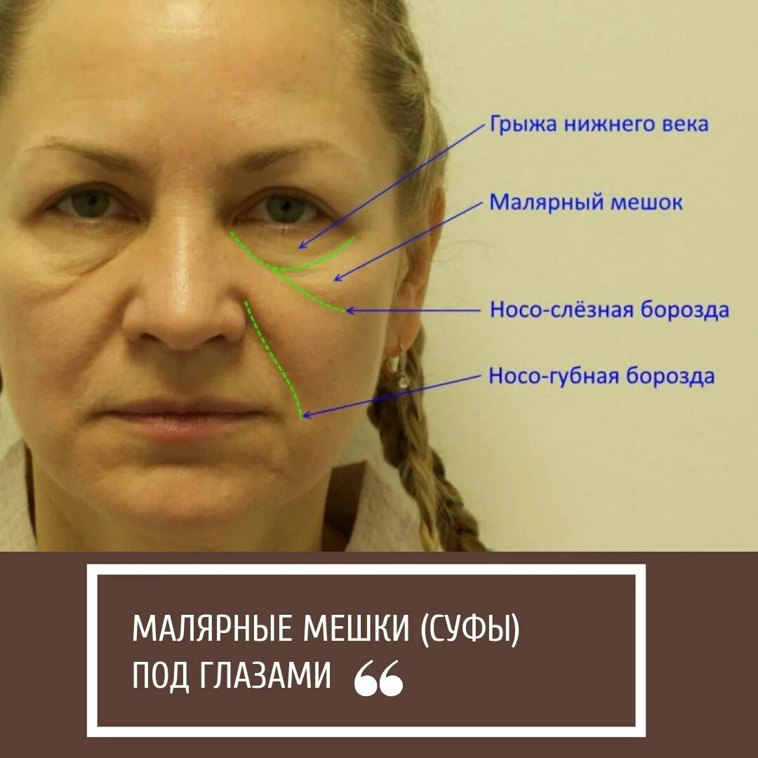 Грыжи скулы