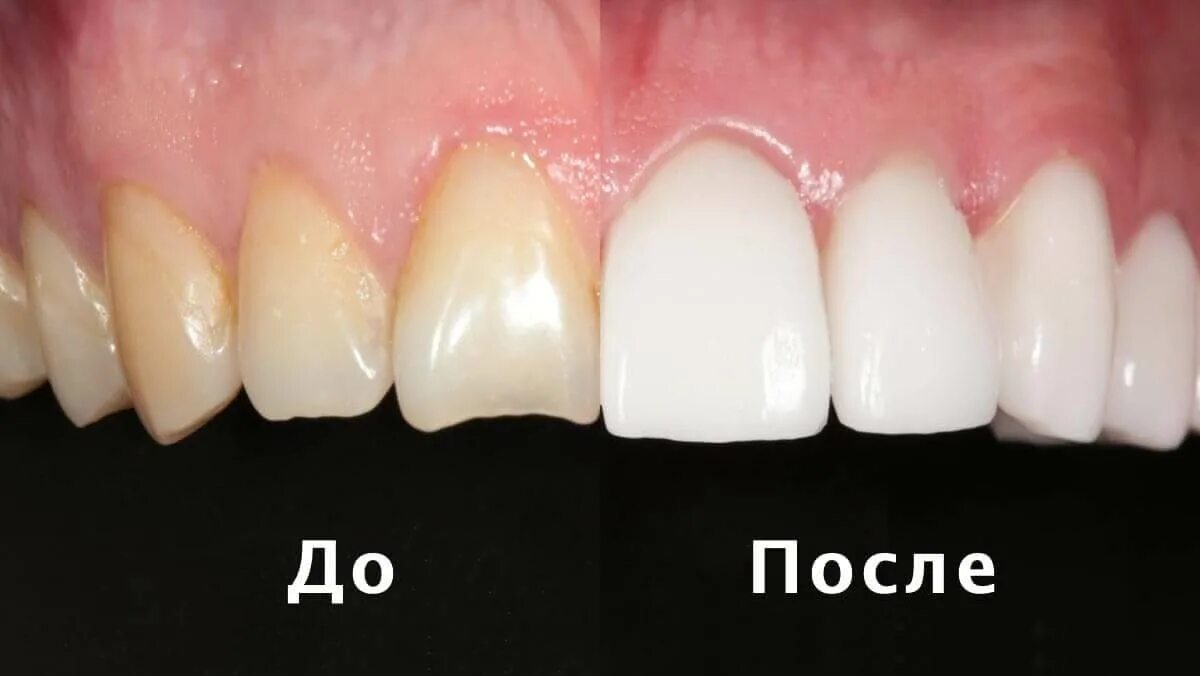 Виниры из композитного материала