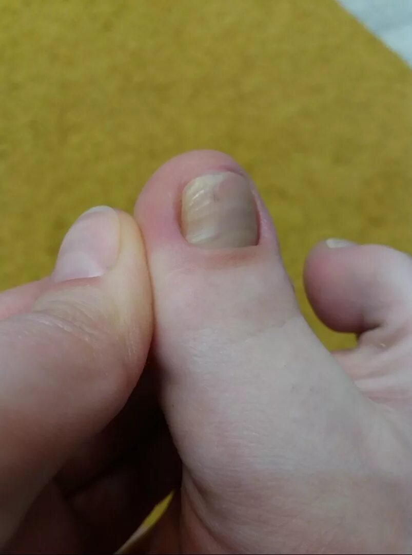 Лечение продольных полос на ногтях. Продольная полоса на ногте большого пальца ноги. Продольная меланонихия. Продольные полоски на ногтях.