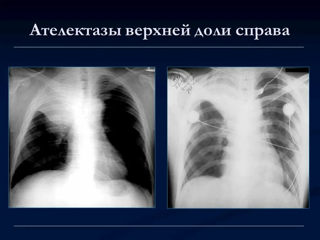 Сегментарный ателектаз рентген. Ателектаз верхней доли рентген. Ателектаз s9. Обтурационный ателектаз рентген. Ателектаз нижнего легкого