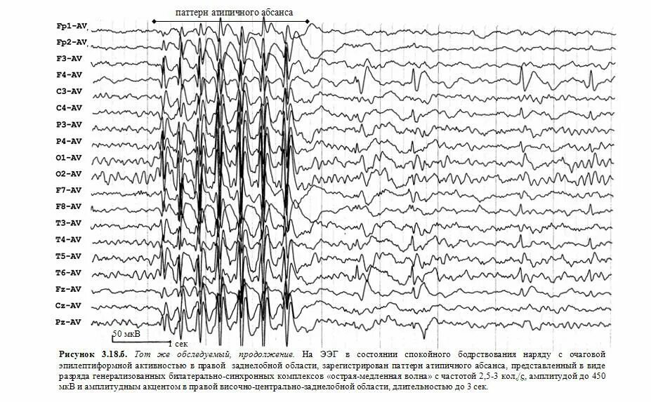 Диффузные эпилептиформные. Эпилептические паттерны на ЭЭГ. Вертексные потенциалы на ЭЭГ. ЭЭГ здорового человека и эпилептика. Генерализованная эпилепсия ЭЭГ.