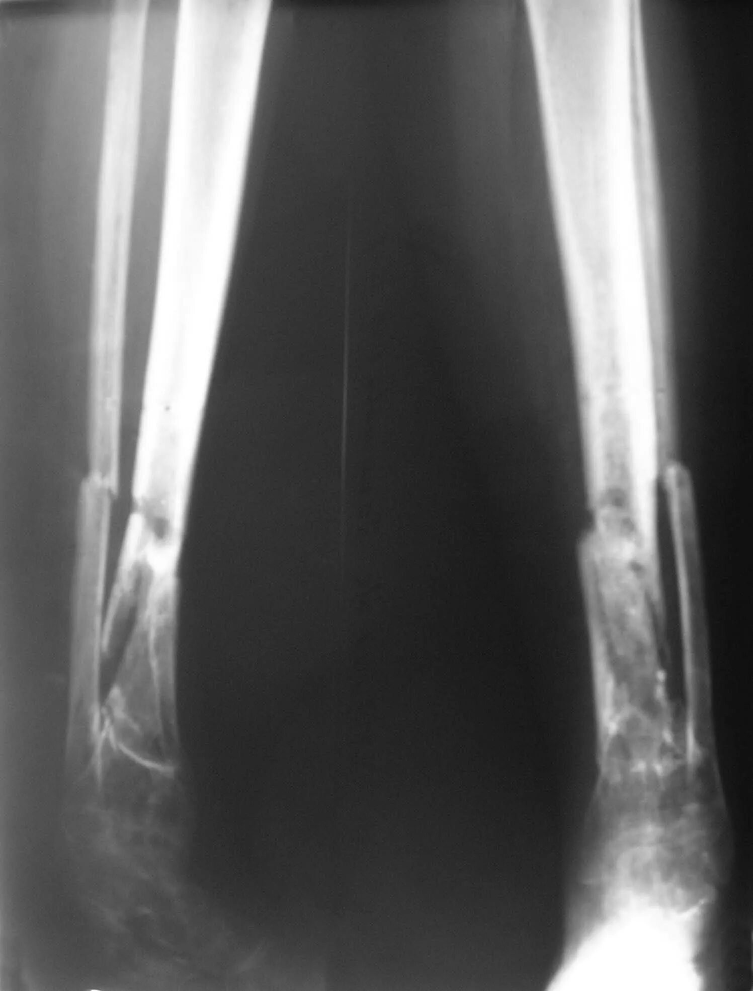 как лечить остеомиелит кости. остеомиелит гарре гистология. первично хронический остеомиелит рентген. как лечить остеомиелит кости. как лечить остеомиелит кости.