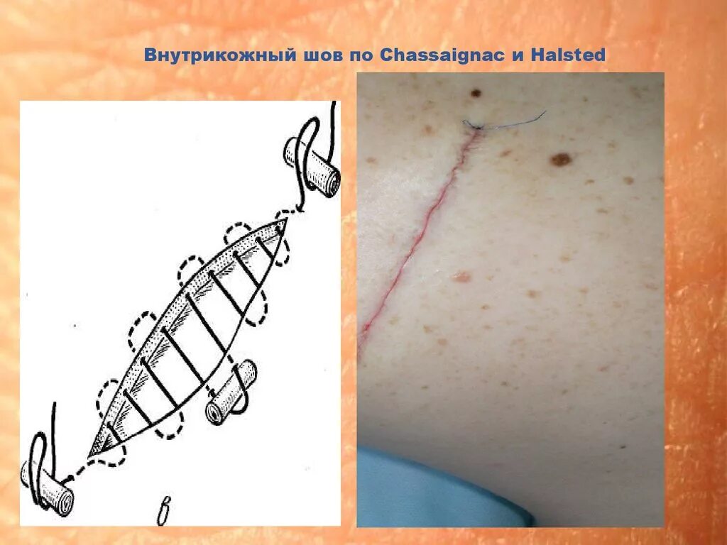 Нить для наложения внутренних швов - найдено 87 картинок