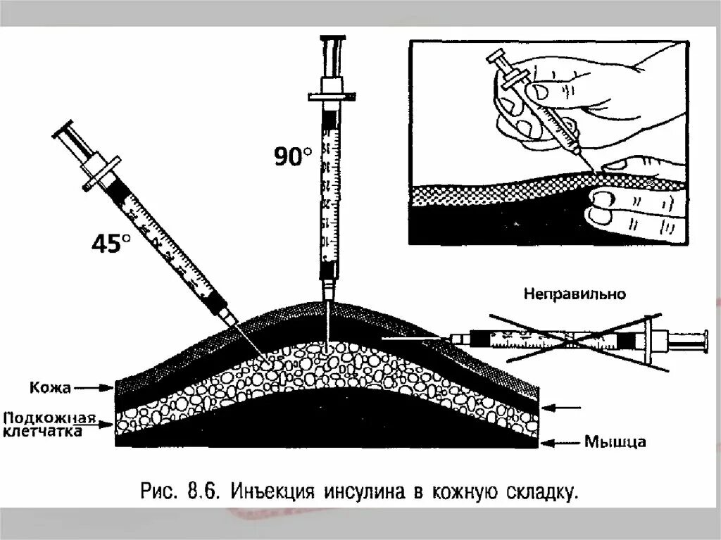 Градусы уколов. Введение инсулина подкожно алгоритм. Укол инсулина под углом 90 градусов. Гепарин подкожно в живот алгоритм. Подкожная инъекция в живот техника.