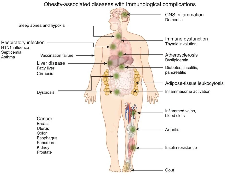 Complications of obesity. Obesity diseases. Diseases associated