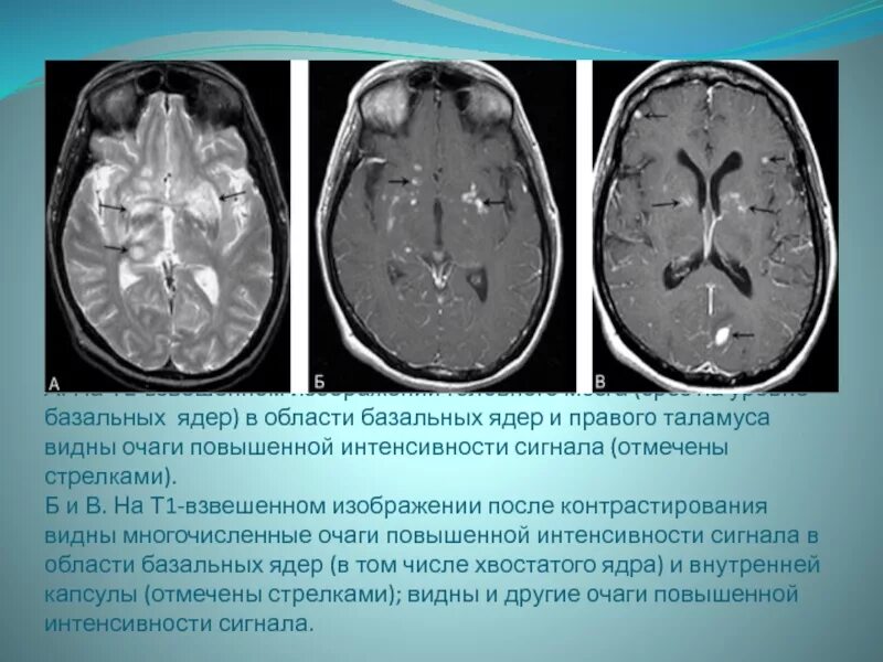 Базальные ядра мозга мрт. Таламус на акт головного мозга. Кистозные изменения головного мозга. Обызвествление базальных ядер. Неспецифические изменения головного мозга