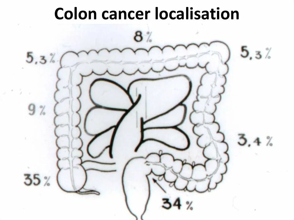 Colorectal Cancer picture localisation. Wear Dark Blue for Colon Cancer. Arcade bordante of Mondor colorectal Cancer. Colon перевод