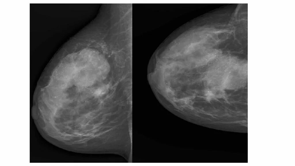 Диффузный фиброаденоматоз молочных желез что это такое. Диффузный фиброаденоматоз.