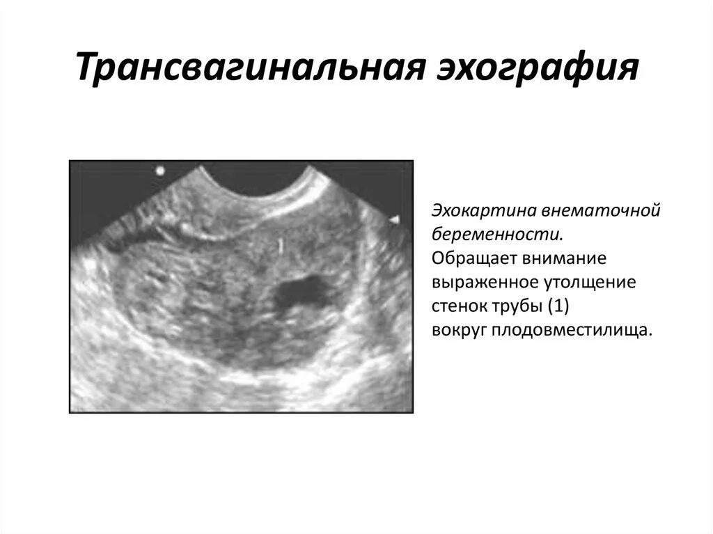 Беременность после внематочной отзывы