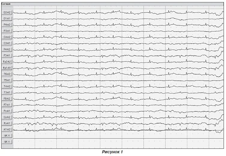 Эпилепсия на ЭЭГ. ЭЭГ Gem 100 Холтер Ates. Результаты ЭЭГ на эпилепсия. Мониторирование ЭЭГ. Здоровая ээг